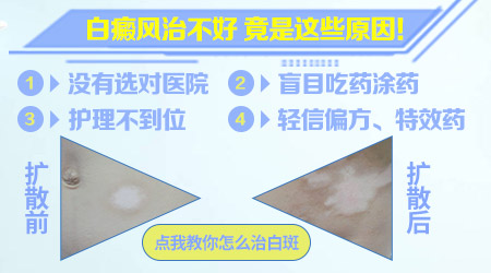 肚子上和脖子处的白斑两年了治不好怎么办