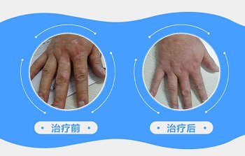 手指白癜风植皮手术后皮肤图