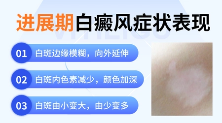 什么是白癜风进展期
