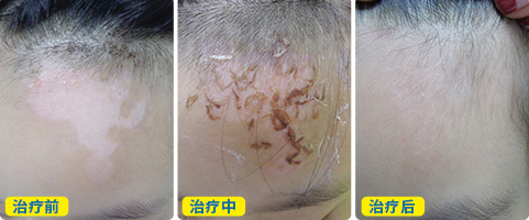 白斑治疗恢复的过程 白斑植皮后的图片