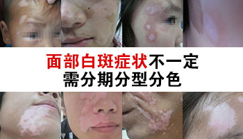 面部白斑初期的图片大全