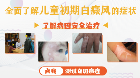 小儿白斑ZUI初期的图片