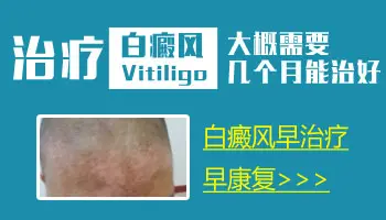 白癜风早期图片 白癜风能治好吗