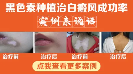 黑色素种植治白斑 石家庄平价医院专治白癜风