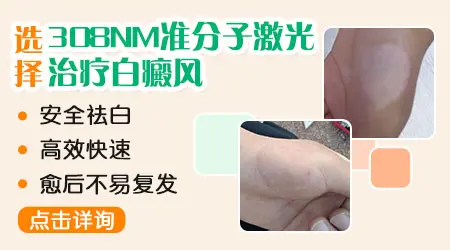 白癜风能不能用308激光治疗