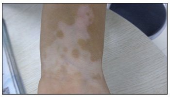 3岁儿童胳膊上淡白色光滑白斑是什么