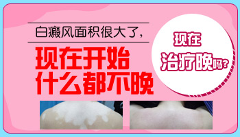 怎么计算身上白癜风的面积