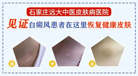 石家庄哪个白癜风专科医院效果好