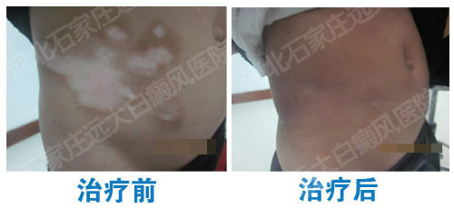 白癜风变成瓷白能治好吗