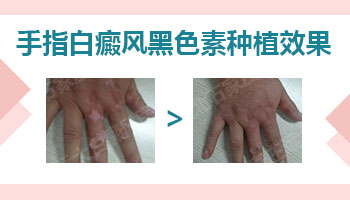 手指白癜风植皮恢复效果图
