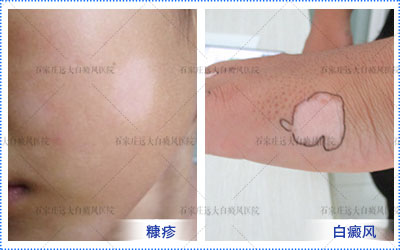 3岁小孩鼻头有白点什么原因造成的