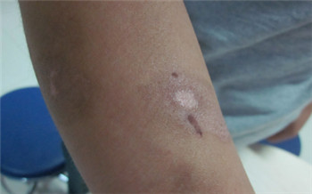 儿童胳膊上有白斑图片大全