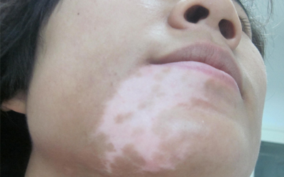 整个下巴发白怎么判断是不是得了白癜风