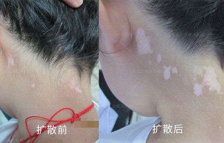 孩子脖子有片白还扩散