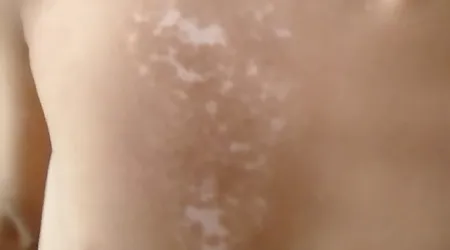 女性胸部出现白块白点怎么回事