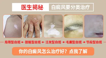 石家庄远大白斑医院能治好白癜风吗