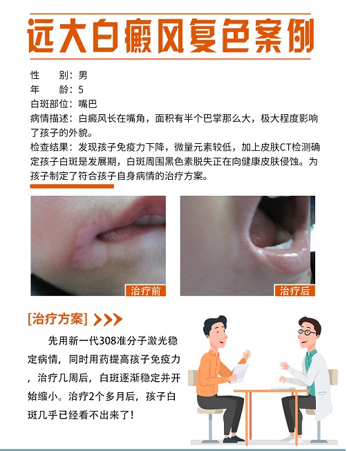 白癜风激光照了三次都不发红正常吗