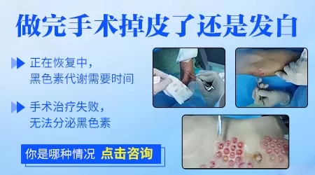 白癜风种植手术2个月没长黑色素是失败吗