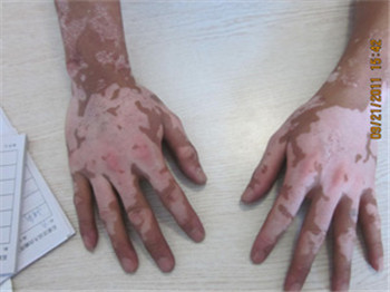 男性手指骨节长白癜风的初期图片