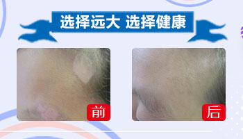 发现宝宝头部有白癜风该怎么治