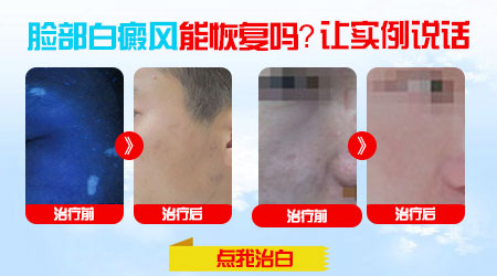 脸有一块比其他地方白是得了白癜风吗