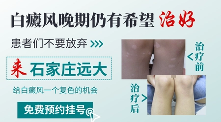 白癜风是可以治好的吗