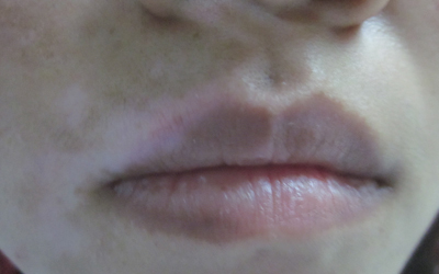 嘴唇白斑ZUI初期的图片