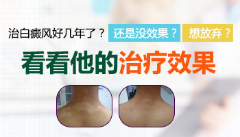 白癜风好几年了一直没扩散可以治好吗