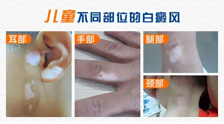 儿童白癜风初期有哪些症状图片
