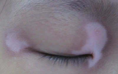 孩子眼角上面有块白斑这是什么病