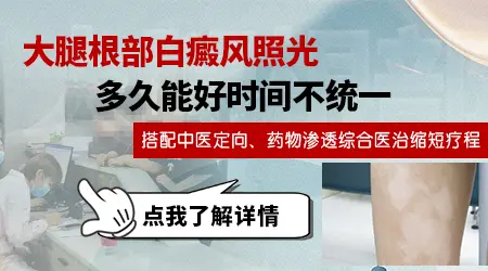 腿上大面积的白癜风照uvb好还是308激光好