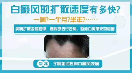 白癜风有可能身上就长一个吗