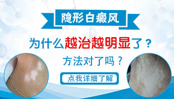 白癜风照射308以后越来越白怎么回事