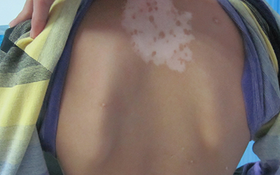 背部局限型白癜风的治疗方法有哪几种