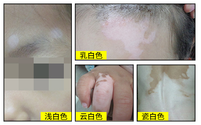 白癜风白斑在初期的症状是什么样