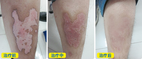 白斑治疗恢复的过程 白斑植皮后的图片