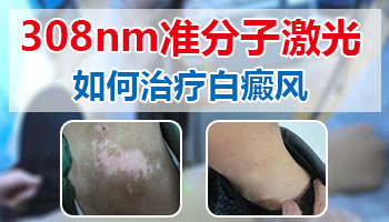 白癜风患者喝着药会不会发展新的白斑