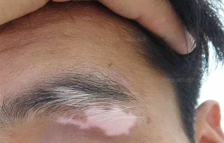 男性眉毛白斑初期图