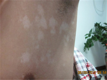 白癜风怎么识别