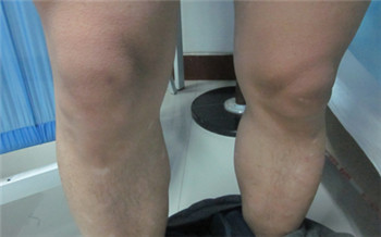 大腿上有一处白色的皮肤跟别的皮肤不一样