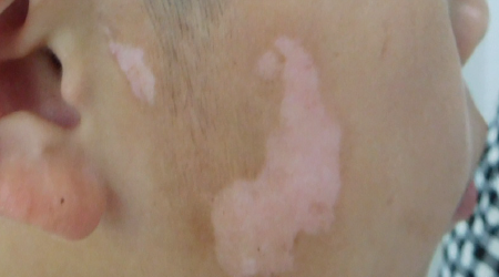 小孩脸上有块白是什么