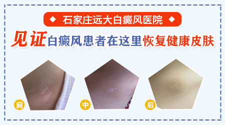 白癜风做308光疗有十多次了感觉效果慢想做手术