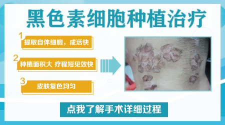 成年人身上白癜风怎么治