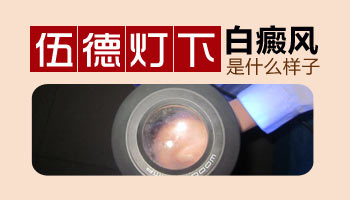 伍德灯检查白癜风图片