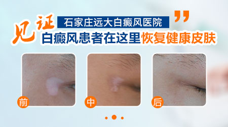 石家庄市白癜风专科医院有几家