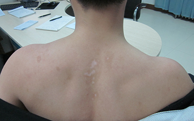 孩子后背白色不规则斑块是什么