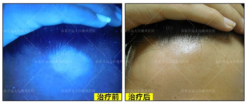 检查白斑照伍德灯准吗