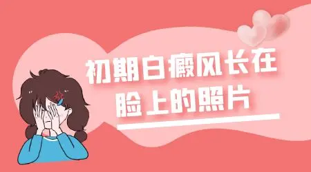 白癜风ZUI初几天的照片