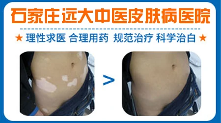 淘宝上治疗白癜风的药靠不靠谱