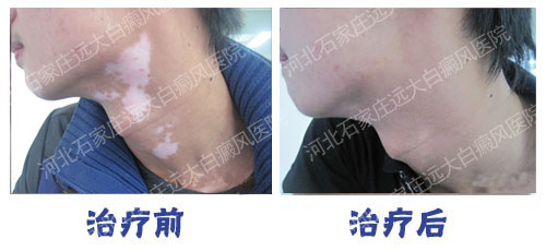 治疗复发型白癜风需要花多少钱